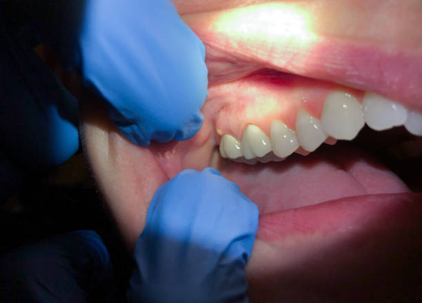 Best Emergency Root Canal Therapy in Fruitport, MI